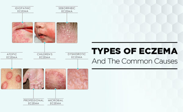 Different Types Of Eczema And It's Common Causes