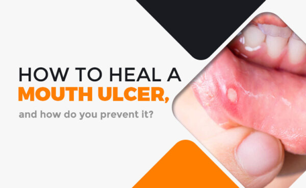 how-to-heal-a-mouth-ulcer-and-how-do-you-prevent-it